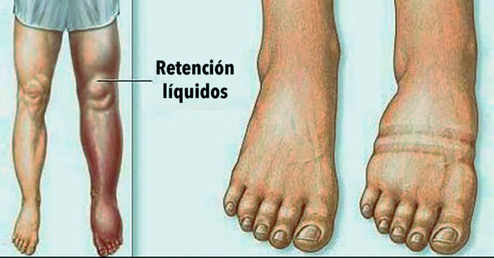 6 Cosas Que Causan La Retención De Líquidos Y Cómo Evitarla Naxio 6375