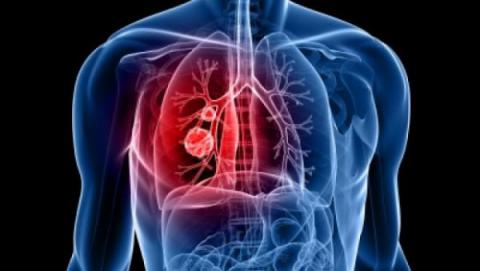 Cáncer de pulmón: 6 señales que no deberías ignorar para detectarlo a tiempo