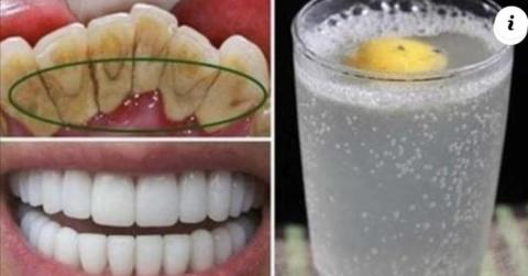 BLANQUEA TUS DIENTES Y ELIMINA TUS CARIES