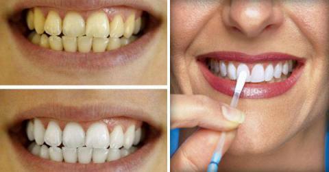 Los Dentistas ocultan esto. El método más rápido y eficaz para blanquear dientes