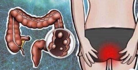 Los síntomas del cáncer de colon que nunca debes ignorar