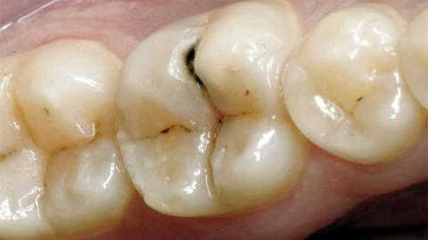 ¡Descubre cómo curar las caries de los dientes para siempre!