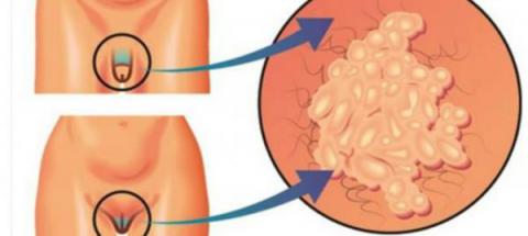 Se cree que muchas personas ya estarían infectadas por esta nueva infección de transmisión sexual