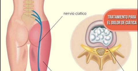 Remedios y Terapia para Quitar el Dolor del Nervio Ciático