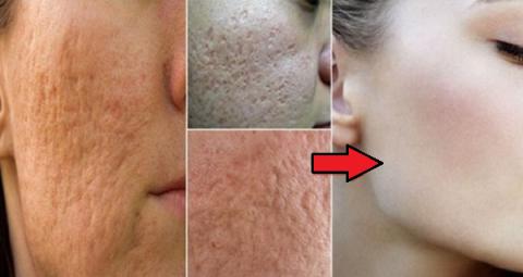 Con estos 4 tratamientos naturales podrás cerrar los poros de tu rostro en solo 3 minutos!