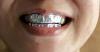 Ella cubrió sus dientes con papel de aluminio por 15 minutos. ¡El resultado te sorprenderá!