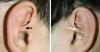 1 de cada 100 personas nace con este orificio extra en la oreja. ¿Sabes por qué?