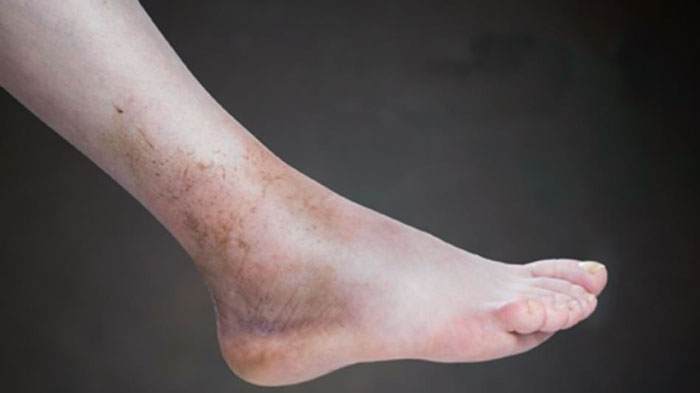 ejercicios para la mala circulacion en los pies, varices